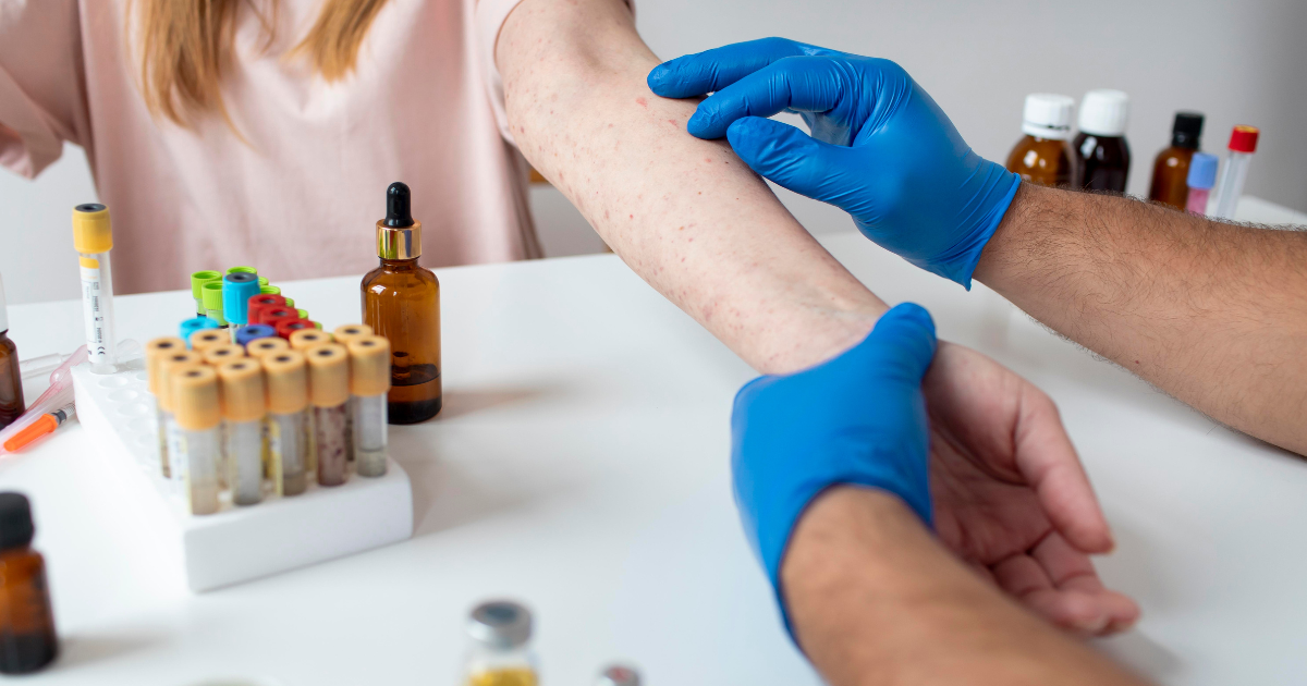 scabies treatment non prescription