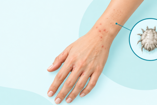 Scabies symptoms