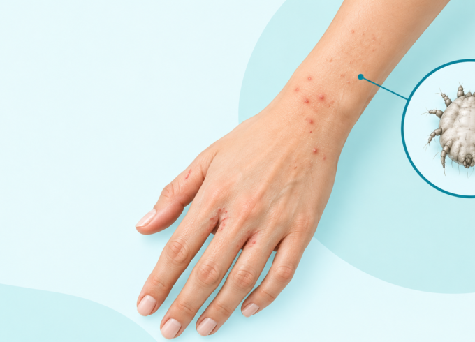 Scabies symptoms